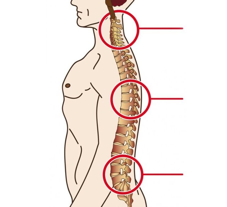 a nyaki, mellkasi és ágyéki osteochondrosis lokalizációja
