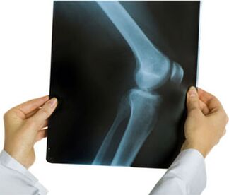 A térd arthrosisának röntgenfelvétele
